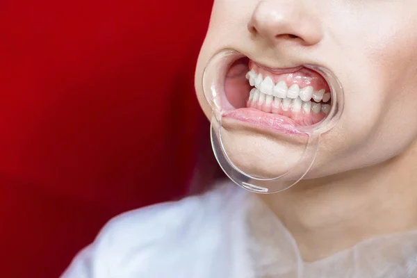 Bělení Zubů Dívka Otevřenou Pusou Kapucí Gel Nanáší Zuby — Stock fotografie