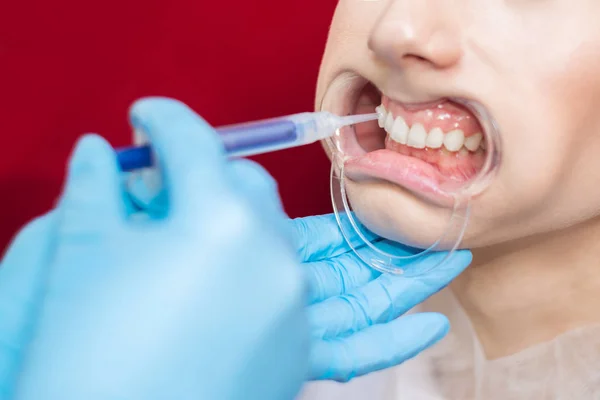 Zubař Aplikuje Injekční Stříkačkou Gel Bělení Zubů Dívka Otevřenými Ústy — Stock fotografie