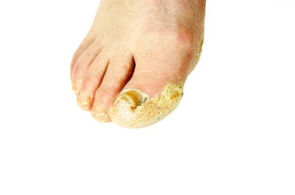 严重不良足部皮肤细菌性真菌感染与受损指甲关闭部分隔绝白色背景 — 图库照片