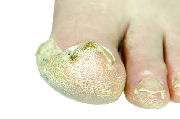 Infected Toenail (A Guide To Help Tell What Type Of Infection You Have)