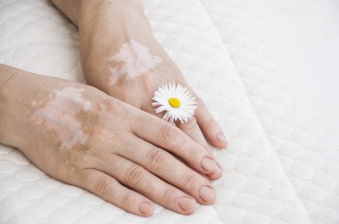 A hand with vitiligo skin condition clipart