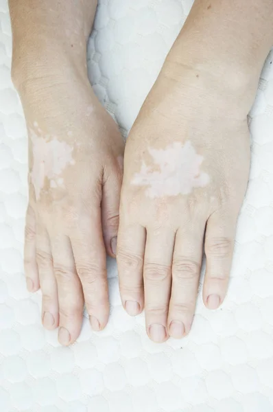 Een hand met vitiligo huidaandoening — Stockfoto