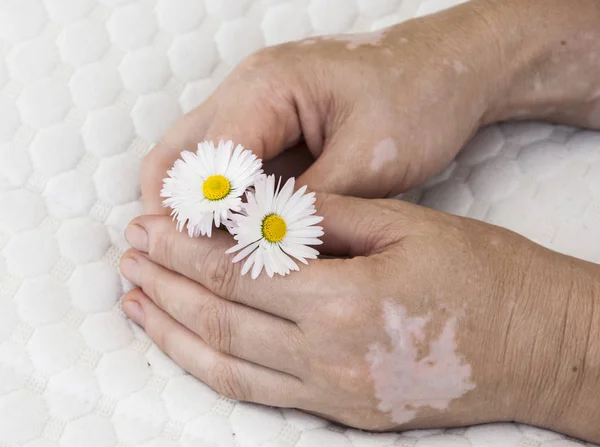 Una mano con enfermedad de la piel del vitiligo —  Fotos de Stock