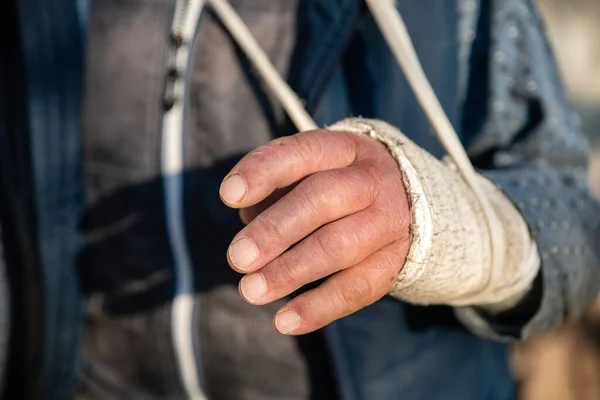 Aufgeschwollene Gebrochene Hand Eines Alten Mannes Schmutziger Weißer Binde Stockbild