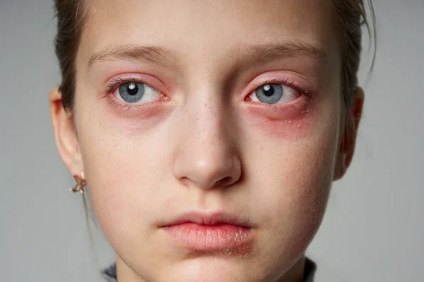 Allergic reaction, skin rash, close view portrait of a girl's face. Redness and inflammation of the skin in the eyes and lips. Immune system disease. — Stock Photo, Image