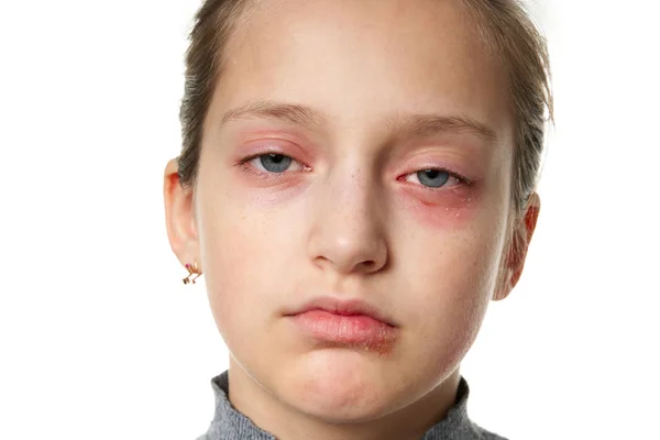Reação alérgica, erupção cutânea, visão de perto retrato do rosto de uma menina. Vermelhidão e inflamação da pele nos olhos e lábios. Doença do sistema imunitário . — Fotografia de Stock
