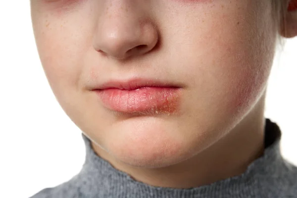 Reação alérgica, erupção cutânea, visão de perto retrato do rosto de uma menina. Vermelhidão e inflamação da pele nos olhos e lábios. Doença do sistema imunitário . — Fotografia de Stock