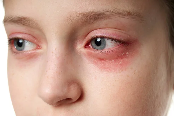 Reaksi alergi, ruam kulit, foto wajah seorang gadis. Kemerahan dan peradangan kulit di mata dan bibir. Penyakit sistem imun . — Stok Foto