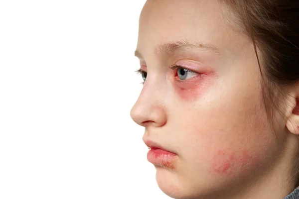 Reacción alérgica, erupción cutánea, retrato de la cara de una niña. Enrojecimiento e inflamación de la piel de los ojos y labios. Enfermedad del sistema inmunitario . — Foto de Stock