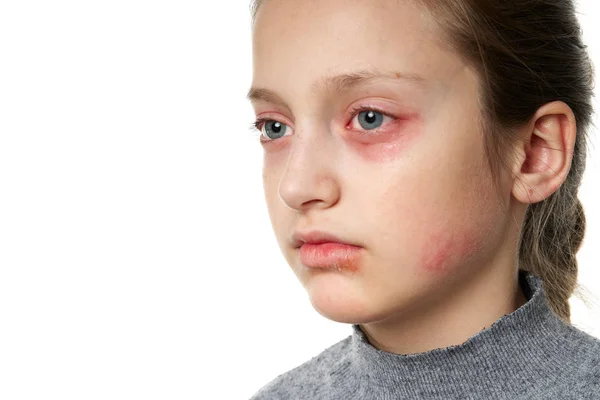 Allergic reaction, skin rash, close view portrait of a girl's face. Redness and inflammation of the skin in the eyes and lips. Immune system disease. — 스톡 사진