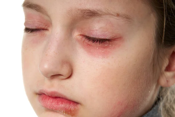 Allergic reaction, skin rash, close view portrait of a girl's face. Redness and inflammation of the skin in the eyes and lips. Immune system disease. — Stock Photo, Image