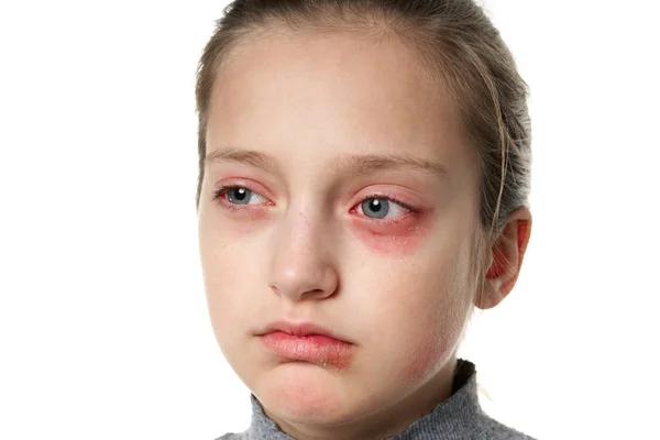 Reacción alérgica, erupción cutánea, retrato de la cara de una niña. Enrojecimiento e inflamación de la piel de los ojos y labios. Enfermedad del sistema inmunitario . — Foto de Stock