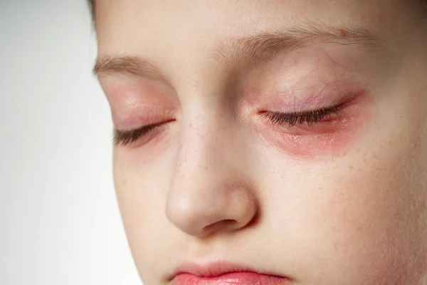 Алергічна реакція, висип шкіри, портрет обличчя дівчини. Почервоніння і запалення шкіри в очах і губах. Хвороби імунної системи . — стокове фото