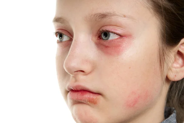 Reação alérgica, erupção cutânea, visão de perto retrato do rosto de uma menina. Vermelhidão e inflamação da pele nos olhos e lábios. Doença do sistema imunitário . — Fotografia de Stock