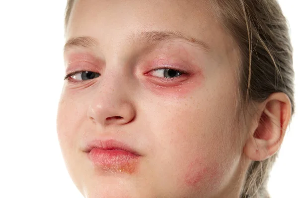 Allergic reaction, skin rash, close view portrait of a girl's face. Redness and inflammation of the skin in the eyes and lips. Immune system disease. — Stock Photo, Image