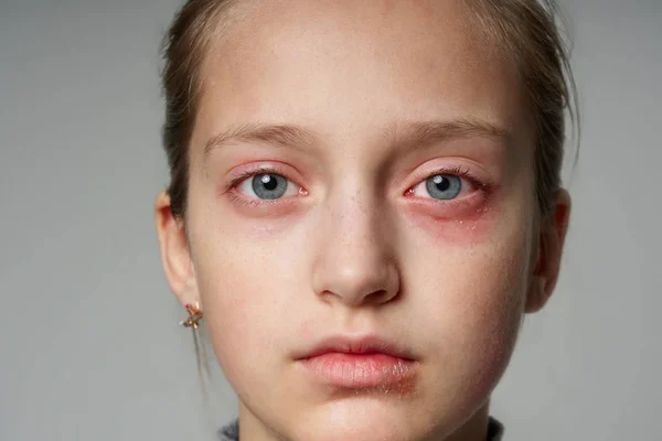 Allergic reaction, skin rash, close view portrait of a girl's face. Redness and inflammation of the skin in the eyes and lips. Immune system disease. — Stock Photo, Image