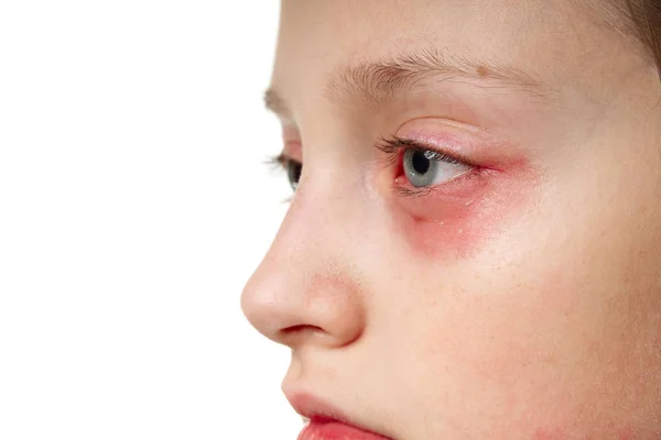 Allergic reaction, skin rash, close view portrait of a girl's face. Redness and inflammation of the skin in the eyes and lips. Immune system disease. — Stock Photo, Image