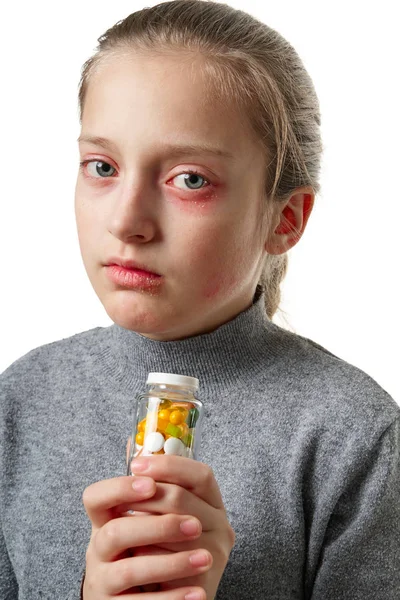 Reacción alérgica, erupción cutánea, retrato de la cara de una niña. Enrojecimiento e inflamación de la piel de los ojos y labios. Enfermedad del sistema inmunológico. Frasco de tabletas y pastillas en la mano del niño . — Foto de Stock