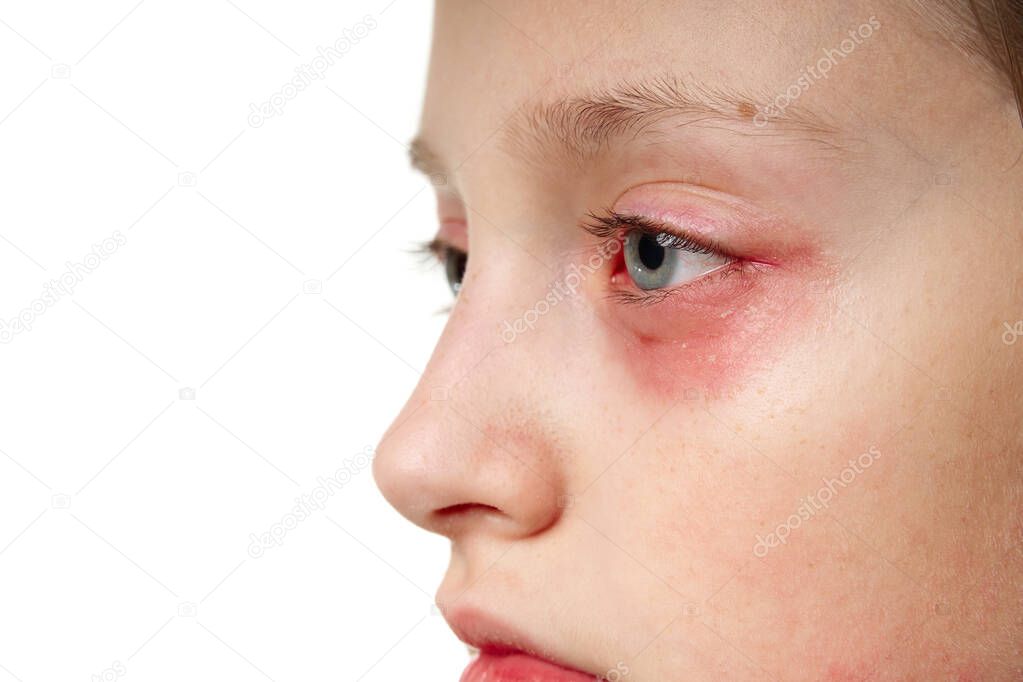 Allergic reaction, skin rash, close view portrait of a girl's face. Redness and inflammation of the skin in the eyes and lips. Immune system disease.