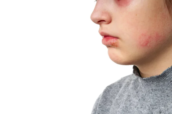 Allergic reaction, skin rash, close view portrait of a girl's face. Redness and inflammation of the skin in the eyes and lips. Immune system disease. — Stock Photo, Image