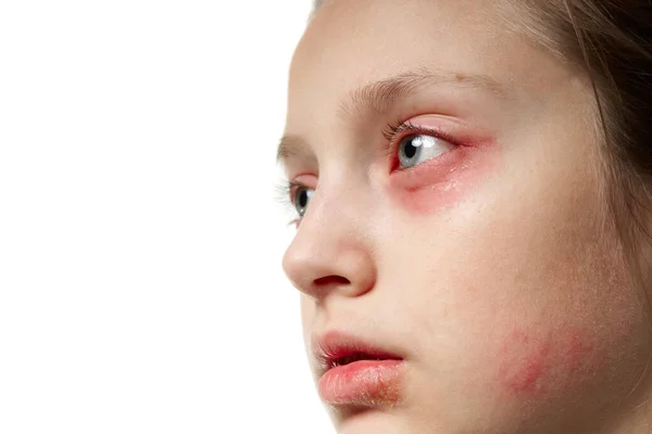 Reacción alérgica, erupción cutánea, retrato de la cara de una niña. Enrojecimiento e inflamación de la piel de los ojos y labios. Enfermedad del sistema inmunitario . — Foto de Stock