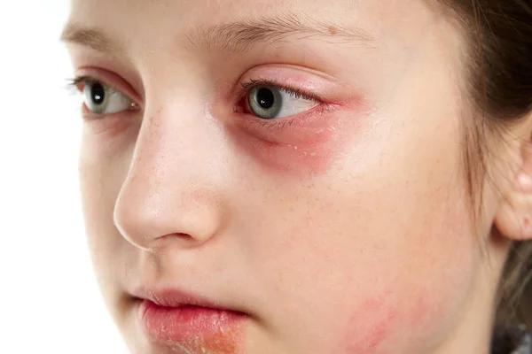 Allergic reaction, skin rash, close view portrait of a girl's face. Redness and inflammation of the skin in the eyes and lips. Immune system disease. — Stock Photo, Image