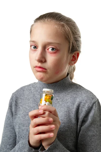 Allergic reaction, skin rash, close view portrait of a girl's face. Redness and inflammation of the skin in the eyes and lips. Immune system disease. Bottle of tablets and pills in child hand. — Stock Photo, Image