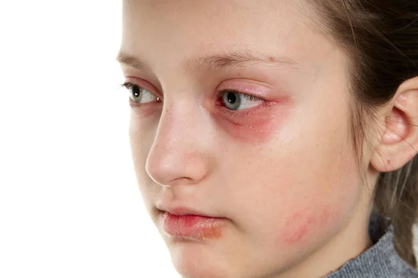 Allergic reaction, skin rash, close view portrait of a girl's face. Redness and inflammation of the skin in the eyes and lips. Immune system disease.