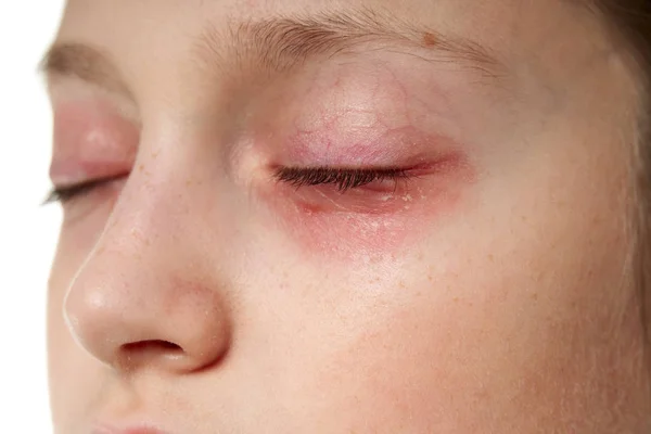 Reacción alérgica, erupción cutánea, retrato de la cara de una niña. Enrojecimiento e inflamación de la piel de los ojos y labios. Enfermedad del sistema inmunitario . — Foto de Stock