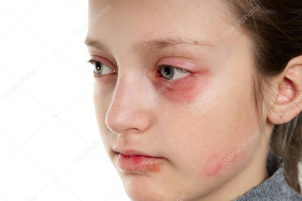 Allergic reaction, skin rash, close view portrait of a girl's face. Redness and inflammation of the skin in the eyes and lips. Immune system disease.