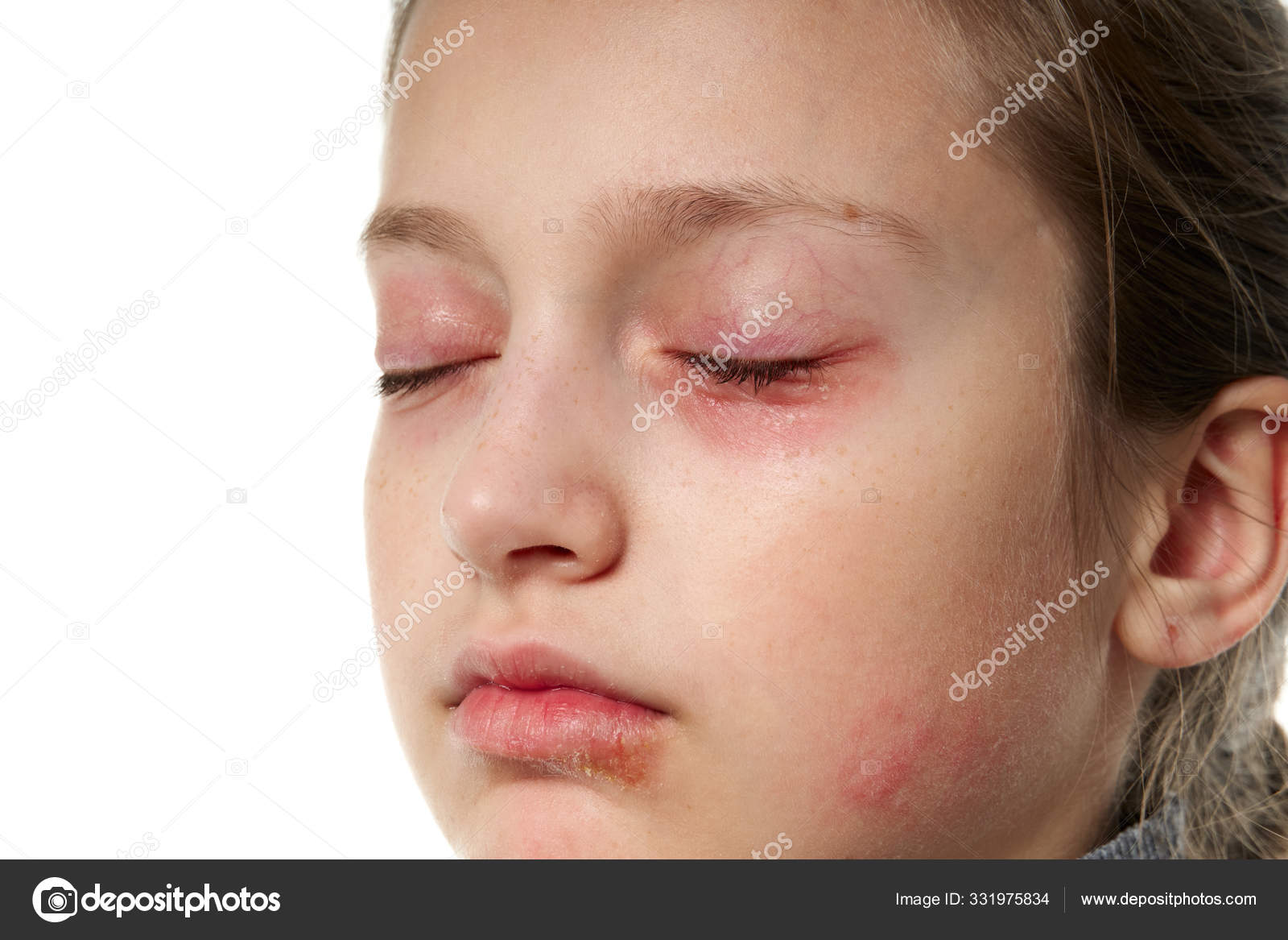 Allergic reaction, skin rash, close view portrait of a girl's face