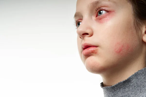 Reacción alérgica, erupción cutánea, retrato de la cara de una niña. Enrojecimiento e inflamación de la piel de los ojos y labios. Enfermedad del sistema inmunitario . — Foto de Stock