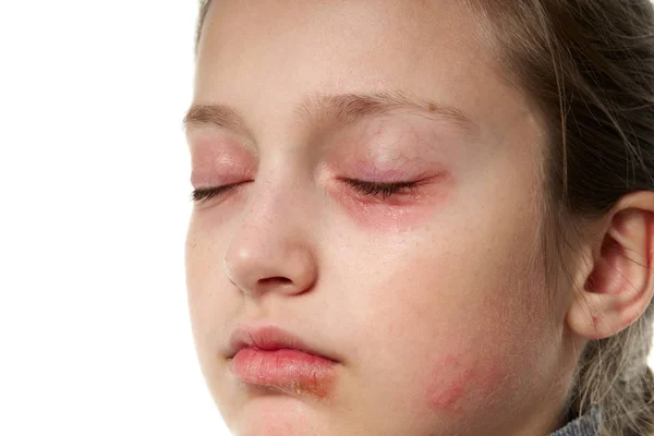 Reacción alérgica, erupción cutánea, retrato de la cara de una niña. Enrojecimiento e inflamación de la piel de los ojos y labios. Enfermedad del sistema inmunitario . — Foto de Stock