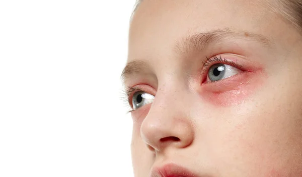 Reakcja alergiczna, wysypka skórna, portret twarzy dziewczyny. Zaczerwienienie i zapalenie skóry w oczach i ustach. Choroba układu odpornościowego. — Zdjęcie stockowe