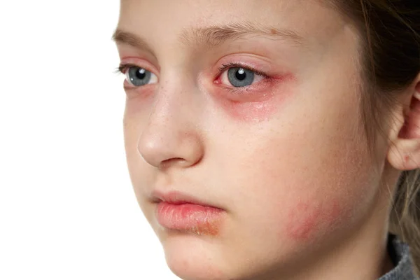 Reação alérgica, erupção cutânea, visão de perto retrato do rosto de uma menina. Vermelhidão e inflamação da pele nos olhos e lábios. Doença do sistema imunitário . — Fotografia de Stock