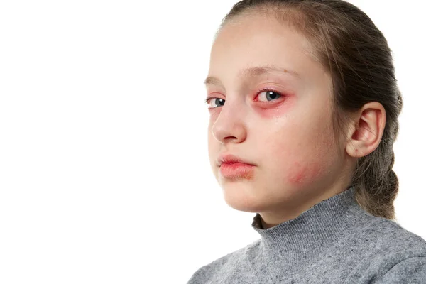 Allergic reaction, skin rash, close view portrait of a girl's face. Redness and inflammation of the skin in the eyes and lips. Immune system disease. — Stockfoto