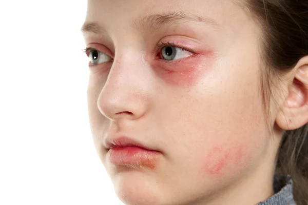 Reação alérgica, erupção cutânea, visão de perto retrato do rosto de uma menina. Vermelhidão e inflamação da pele nos olhos e lábios. Doença do sistema imunitário . — Fotografia de Stock