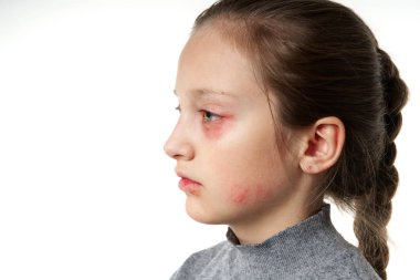 Allergic reaction, skin rash, close view portrait of a girl's face. Redness and inflammation of the skin in the eyes and lips. Immune system disease.