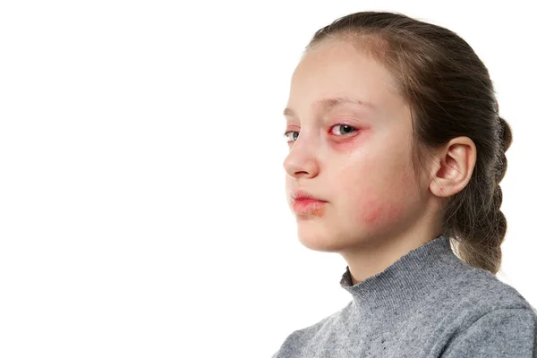 Reacción alérgica, erupción cutánea, retrato de la cara de una niña. Enrojecimiento e inflamación de la piel de los ojos y labios. Enfermedad del sistema inmunitario . — Foto de Stock