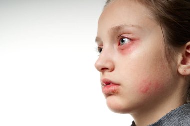 Allergic reaction, skin rash, close view portrait of a girl's face. Redness and inflammation of the skin in the eyes and lips. Immune system disease.