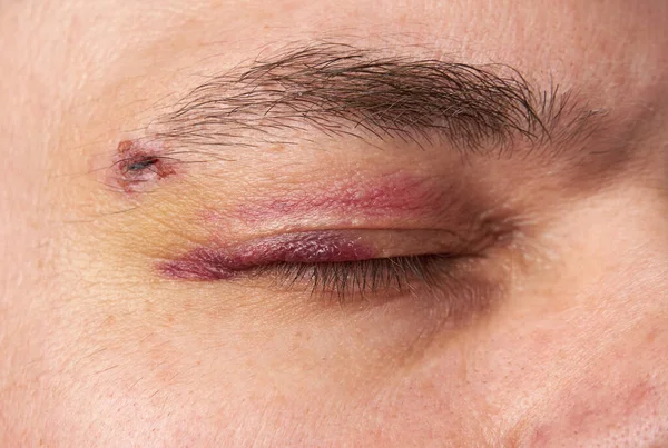 Close View Bruise Eye Face Man Hematoma — Stock Photo, Image