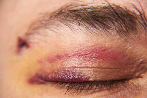 Close View Bruise Eye Face Man Hematoma — Stock Photo, Image