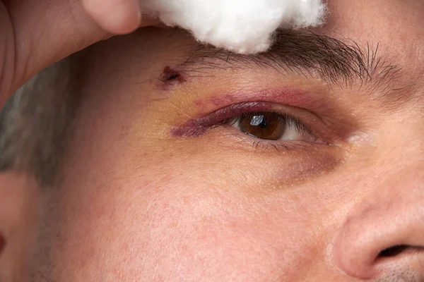 Close View Bruise Eye Face Man Hematoma — Stock Photo, Image