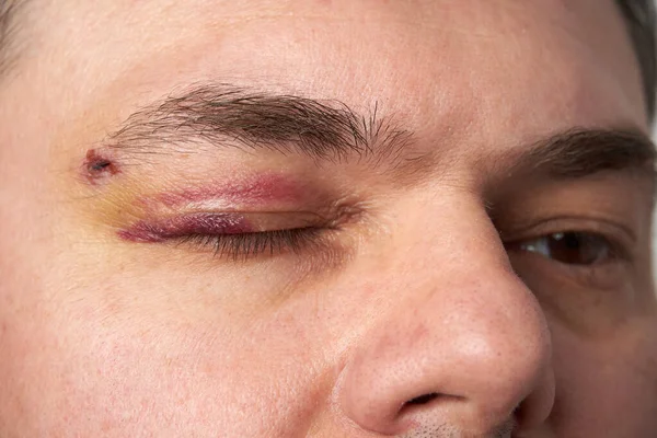 Close View Bruise Eye Face Man Hematoma — Stock Photo, Image