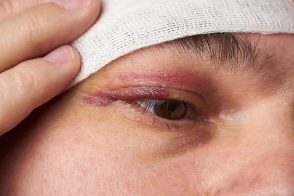 close view of a bruise near the eye, the face of a man with a hematoma