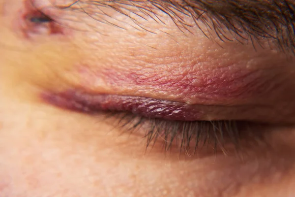 Close View Bruise Eye Face Man Hematoma — Stock Photo, Image