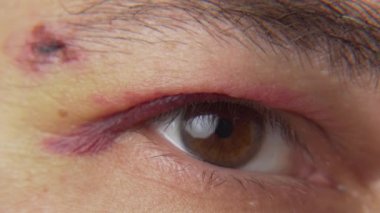 Göze yakın bir morluk, hematomu olan bir adamın yüzü.