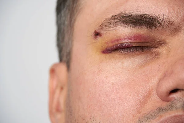 Close View Bruise Eye Face Man Hematoma — Stock Photo, Image