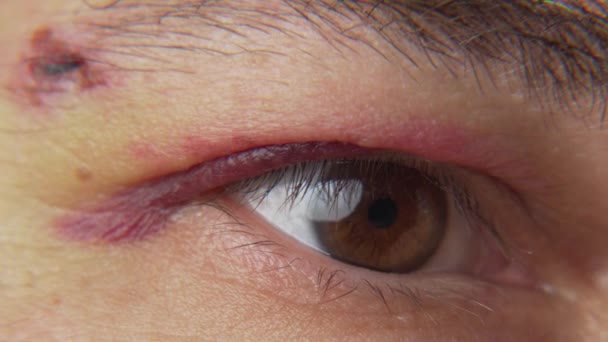 Närbild Ett Blåmärke Nära Ögat Ansiktet Man Med Ett Hematom — Stockvideo