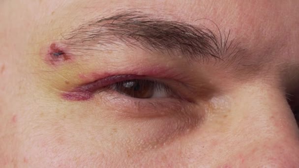近视眼部的伤痕 一个血肿的人的脸 — 图库视频影像